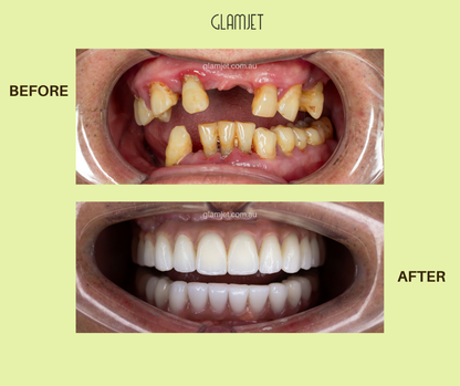 All-on-4 Dental Implants Package In Vietnam. Payment Plans Available