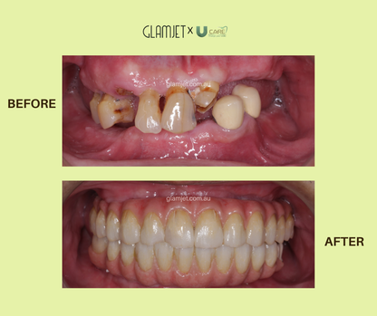 Before and after of all-on-4 dental implants top and bottom at the best dental clinic in Vietnam with Glamjet. 