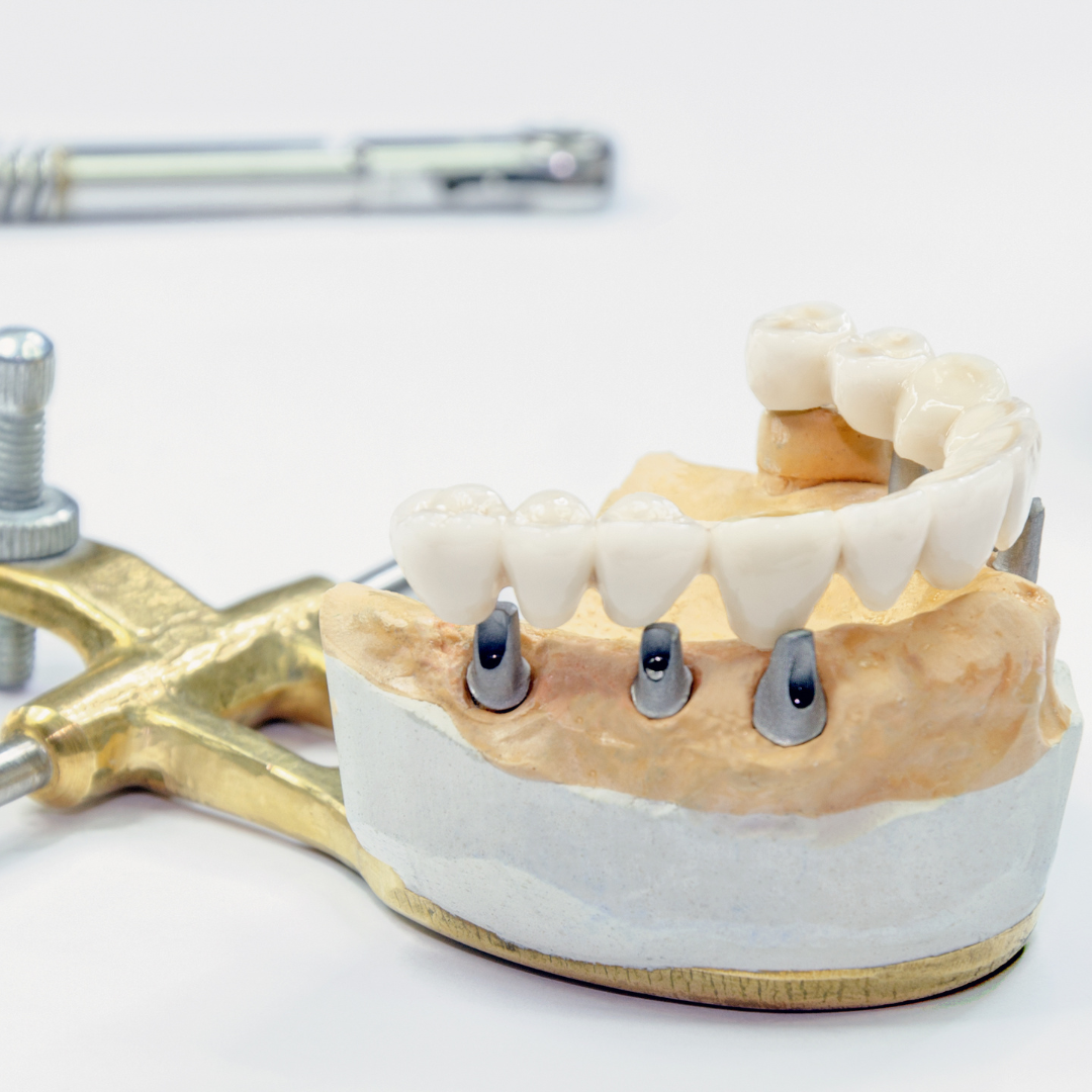 Model and structure of all-on-4 implants. It is the best method for client looking for full mouth dental restoration.  Glamjet works with the best dentists in Ho Chi Minh city in Vietnam who studied in the USA and Europe. They have international experiences and master the art of all-on-4 dental implants. The cost for all-on-4 implants in Ho Chi Minh city, Vietnam is 70%-80% cheaper than in the USA, Australia, and the UK. Glamjet is an Australian company help travellers arrange dental holidays with ease