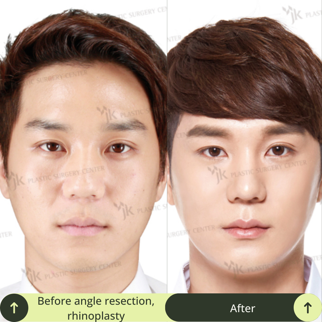 Men Vline Jaw Surgery Packages In South Korea