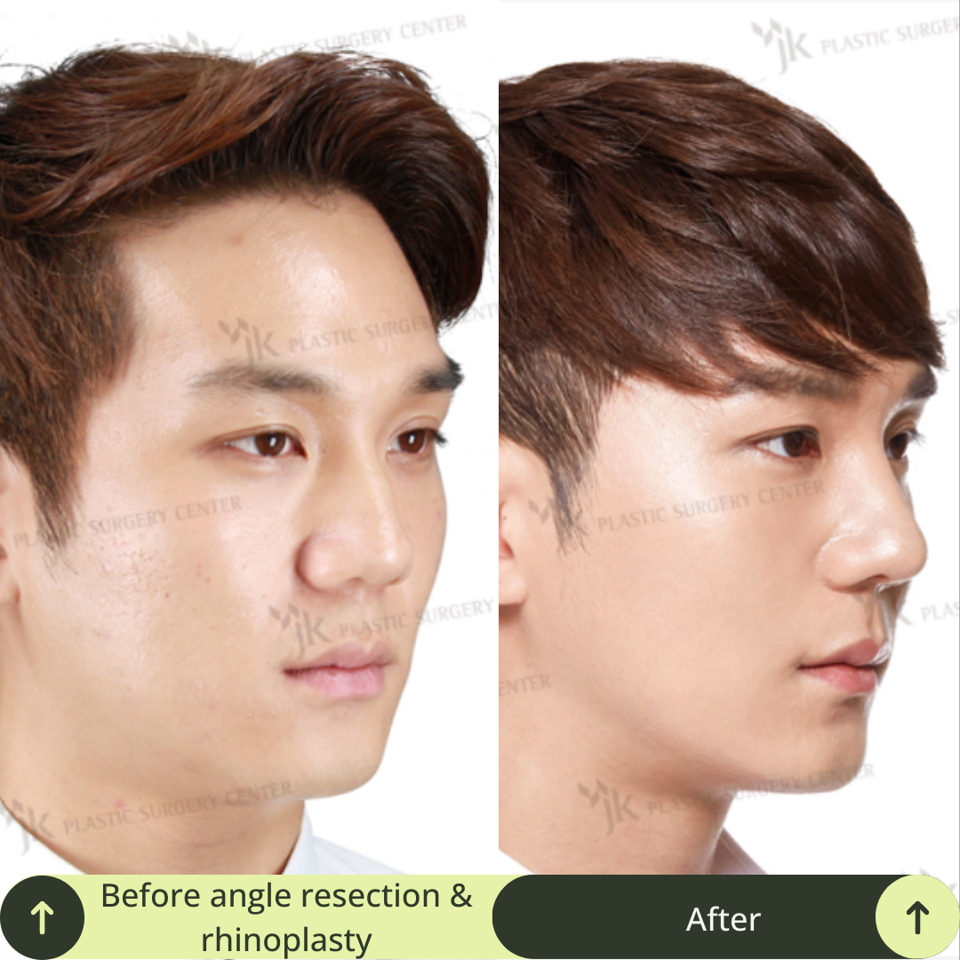 Men Vline Jaw Surgery Packages In South Korea