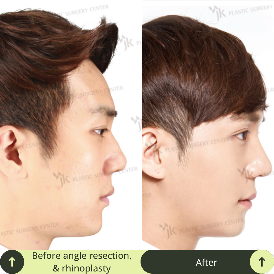 Men Vline Jaw Surgery Packages In South Korea