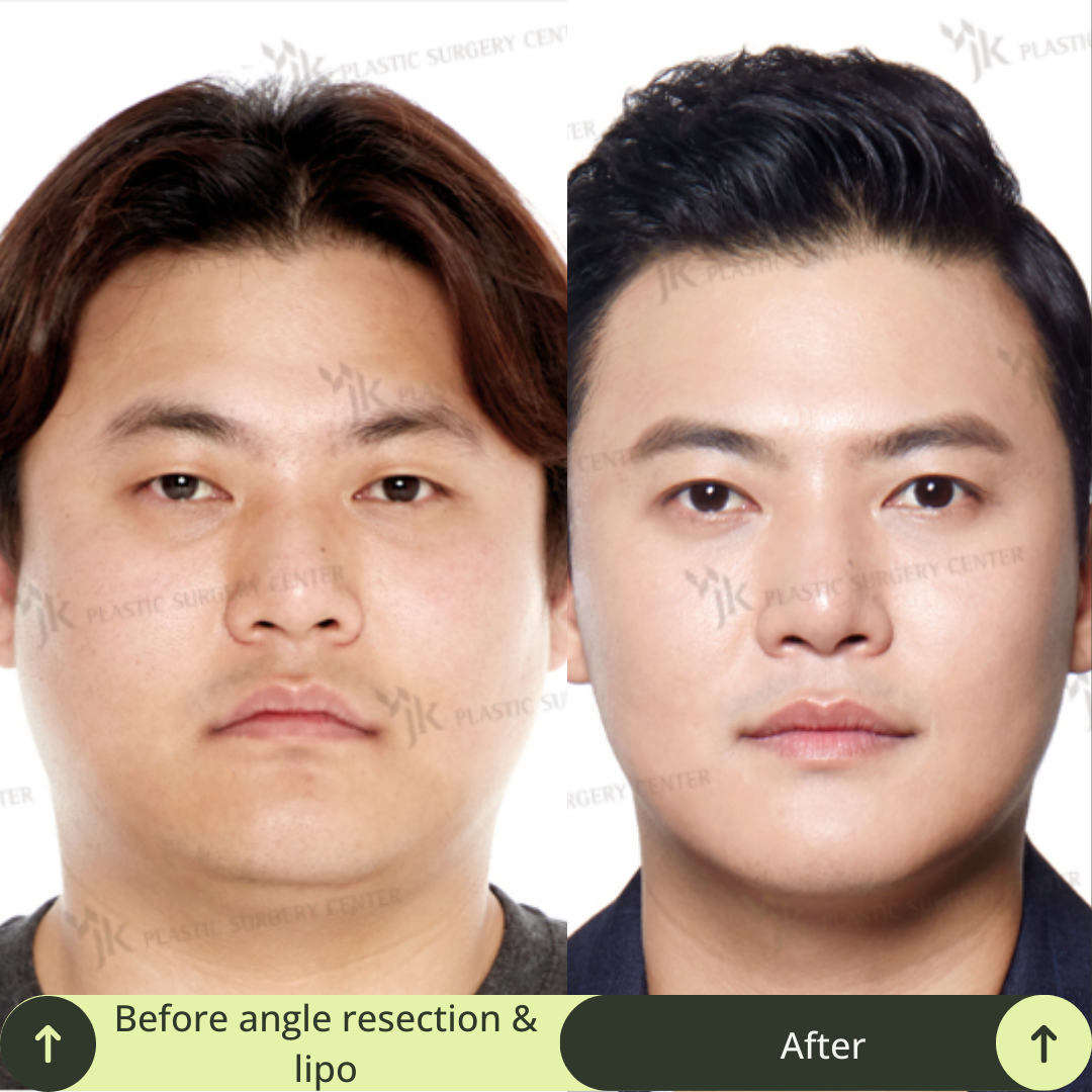 Men Vline Jaw Surgery Packages In South Korea