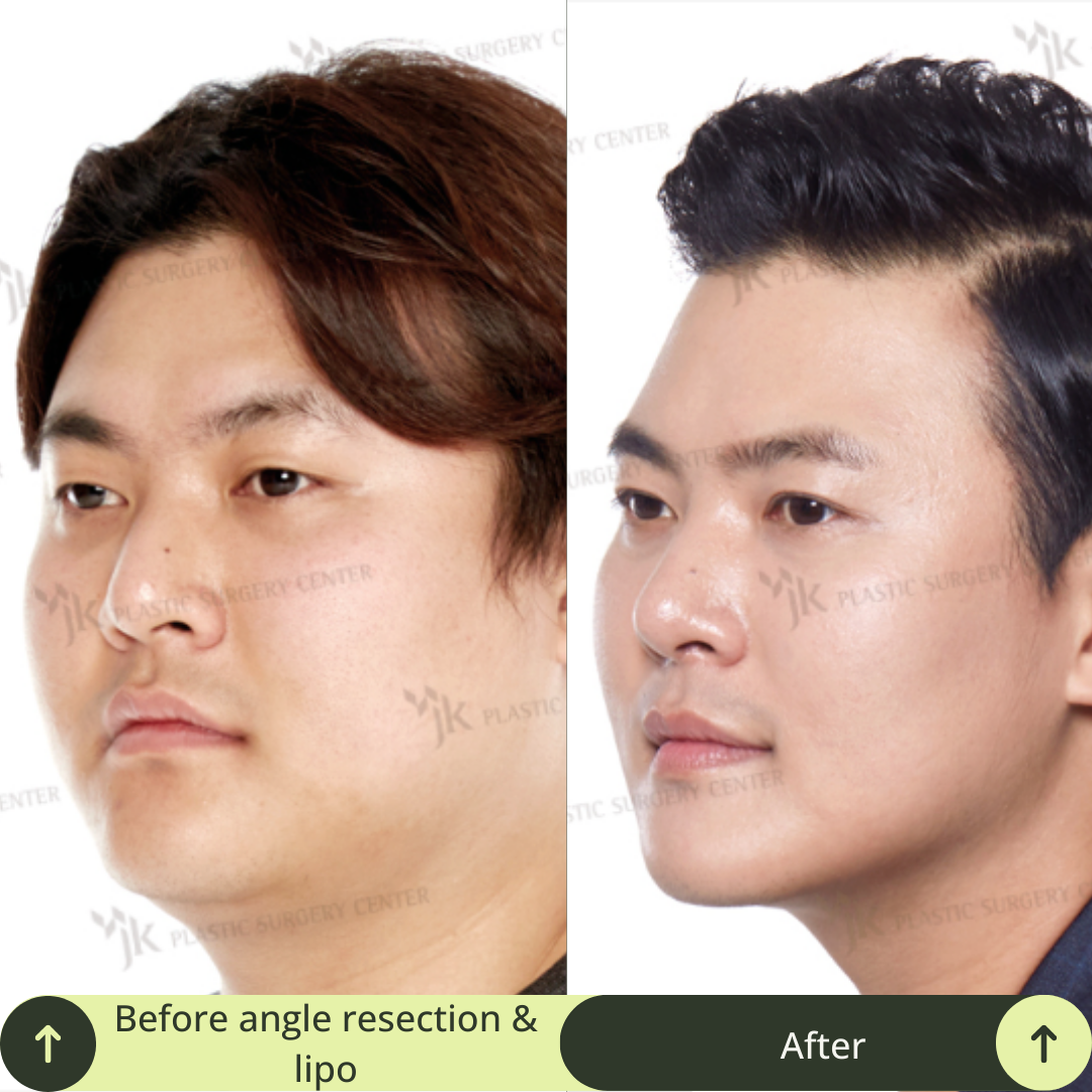 Men Vline Jaw Surgery Packages In South Korea