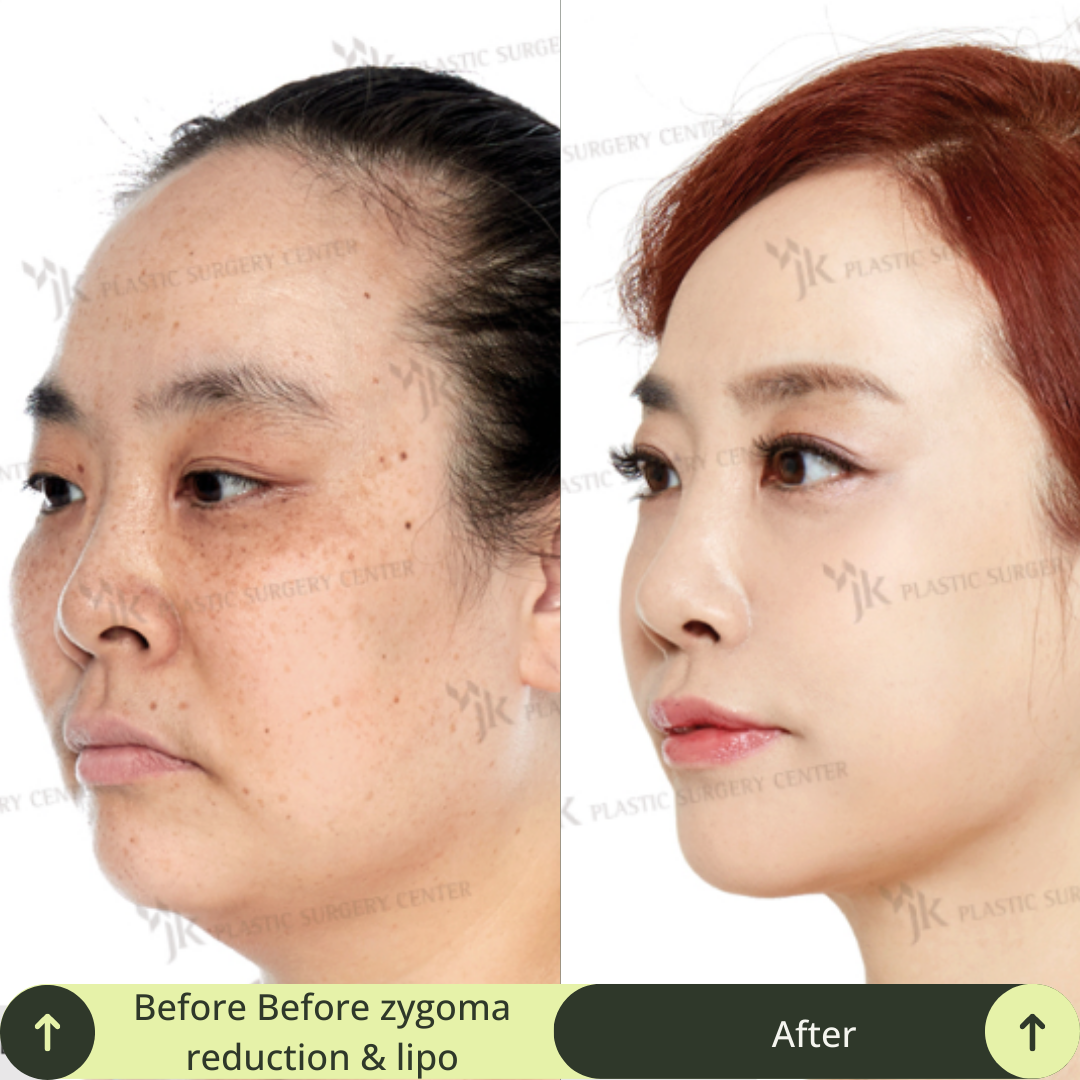 Women Face Contour Surgery Packages In South Korea