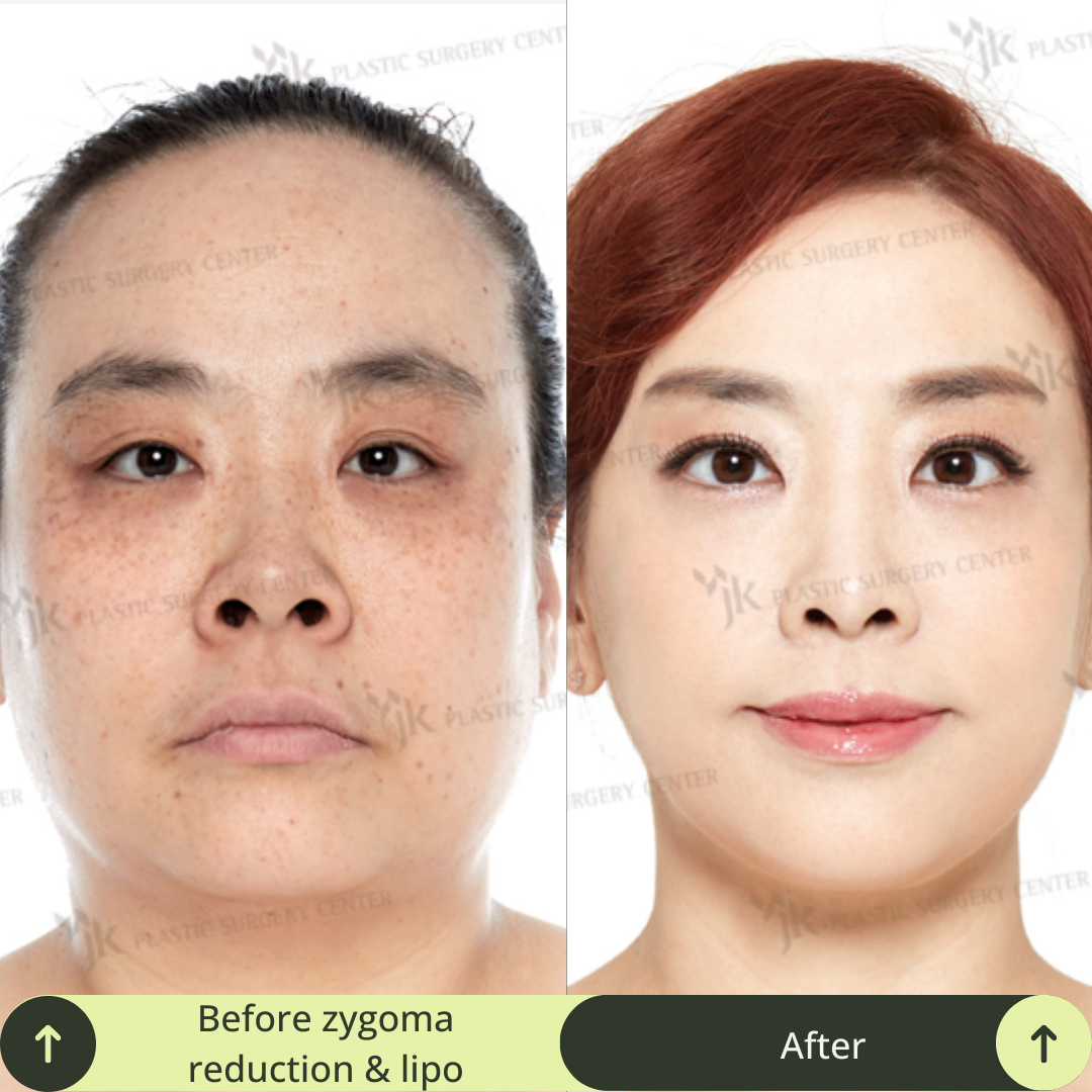 Women Face Contour Surgery Packages In South Korea