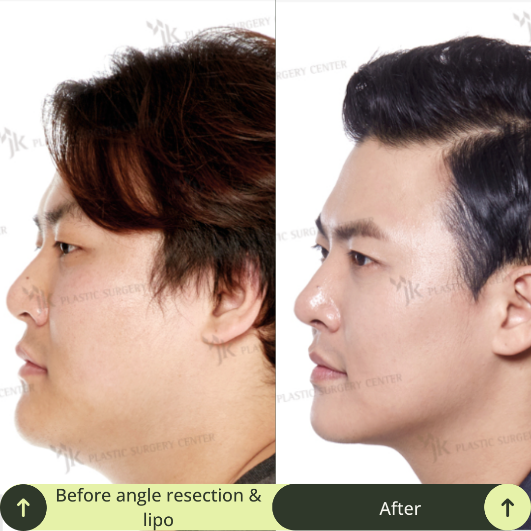 Men Vline Jaw Surgery Packages In South Korea