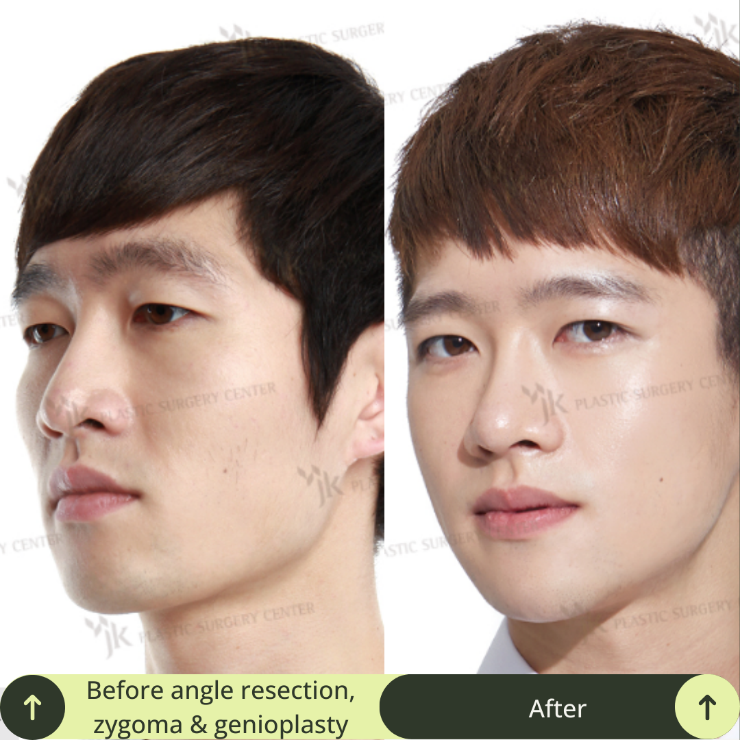 Men Vline Jaw Surgery Packages In South Korea