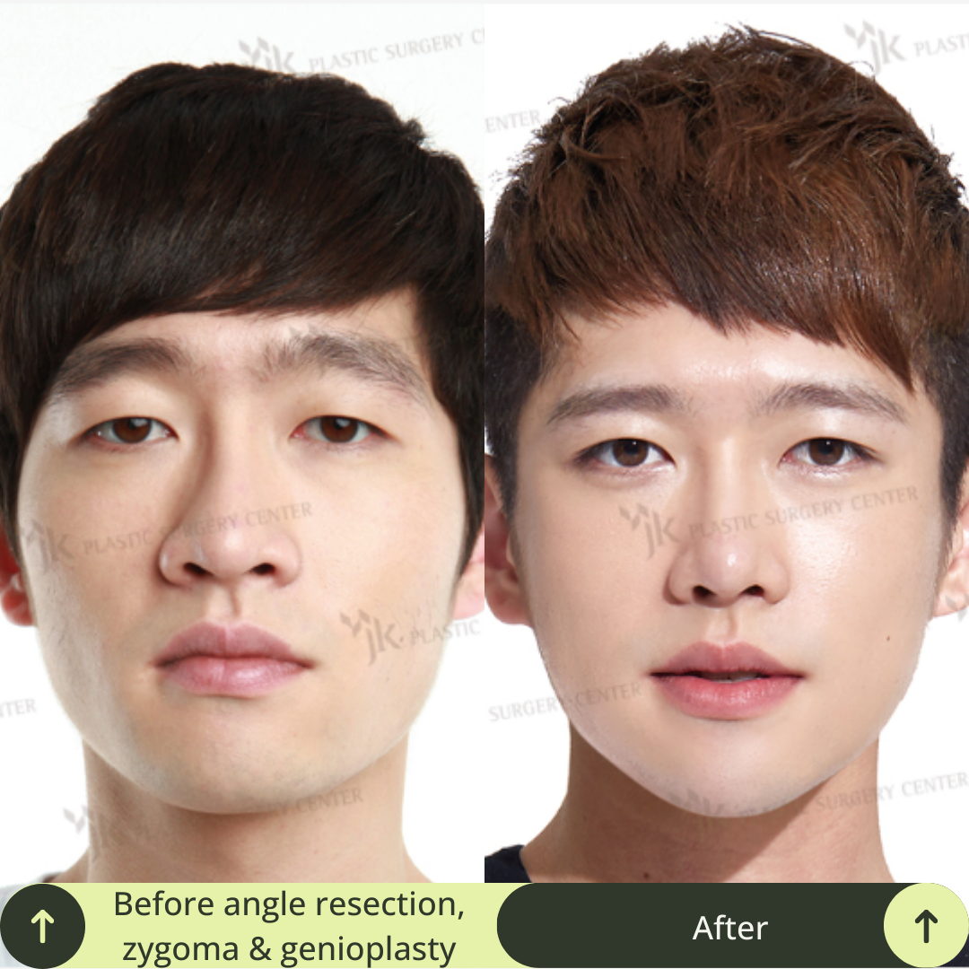 Men Vline Jaw Surgery Packages In South Korea