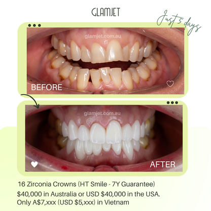 Before and after Darwin client’s crossbite and overbite correction smile transformation with zirconia crowns in Vietnam by Glamjet.com.au.