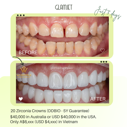 Women Dental Zirconia Crown In Vietnam