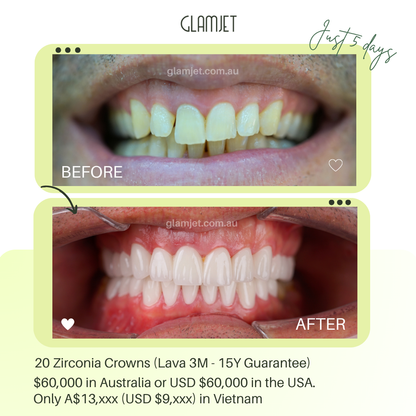 This CEO in Perth, Australia upgraded his professional image with zirconia crowns via Glamjet.com.au. Top dentists in Hanoi and Ho Chi Minh Vietnam, great prices save more than booking direct. Finish in 3–5 days