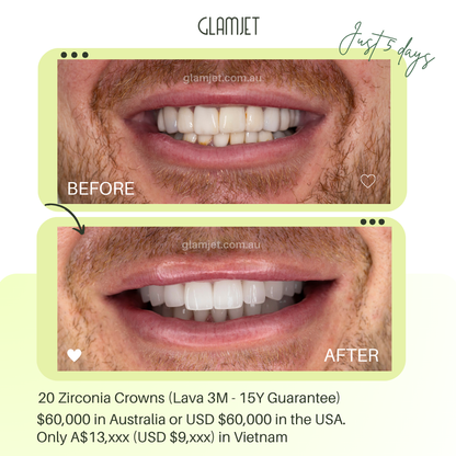 Melbourne executive’s smile makeover with Lava 3M zirconia crowns in Hanoi via Glamjet.com.au  saved $40,000 vs local dental costs and paid with Super. He now has beautiful Hollywood smile