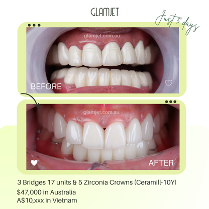 Philippine male nurse’s smile makeover with zirconia crowns and bridges in Vietnam via Glamjet.com.au affordable, natural, and confidence-boosting. You can see before and after images here
