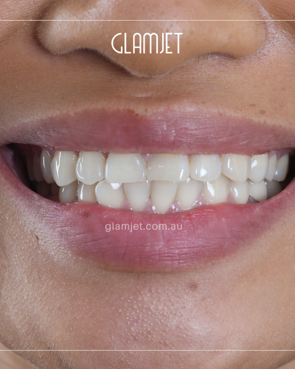 Before - Case 6: 16 Emax veneers