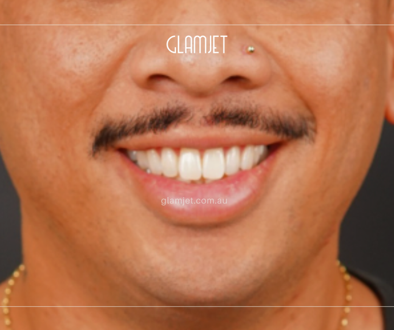 Before - Case 5: 16 Emax veneers and 4 zirconia crowns