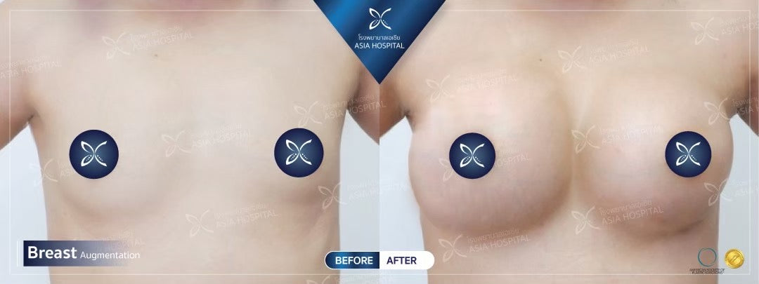 Breast Augmentation Surgery Packages In Thailand