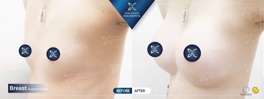 Breast Augmentation Surgery Packages In Thailand