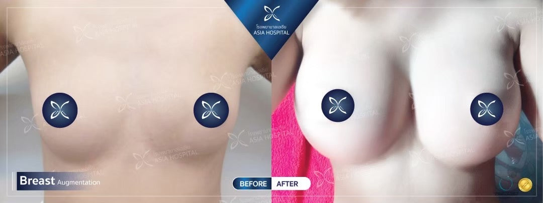 Breast Augmentation Surgery Packages In Thailand