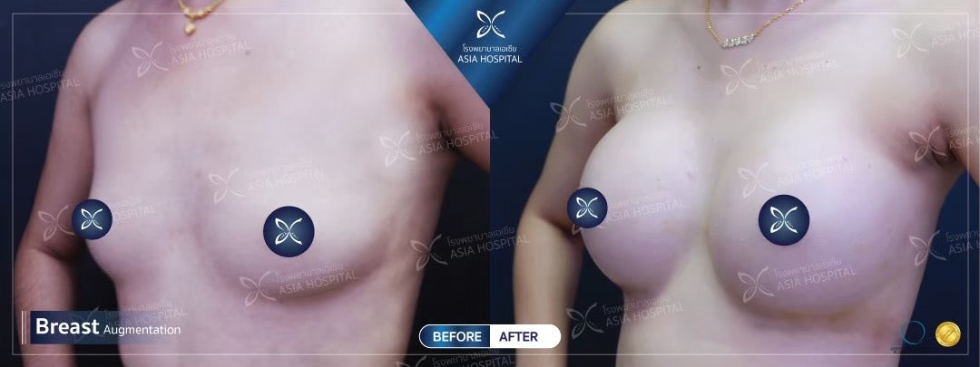 Breast Augmentation Surgery Packages In Thailand