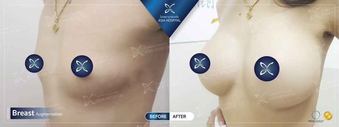 Breast Augmentation Surgery Packages In Thailand