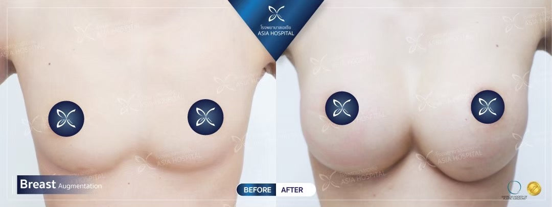 Breast Augmentation Surgery Packages In Thailand