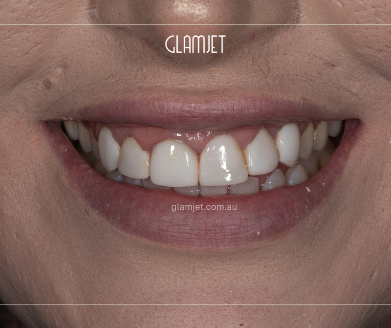 Before - Case 1: Replace composite veneers with 10 Emax veneers