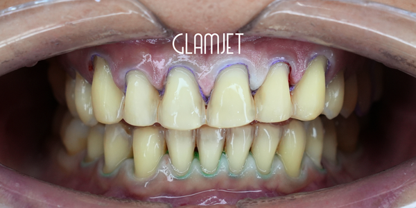 LiSi/Lumineers Veneer