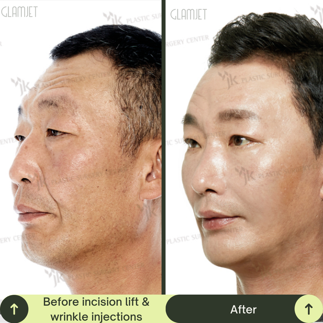 Men Face Lift Packages in South Korea