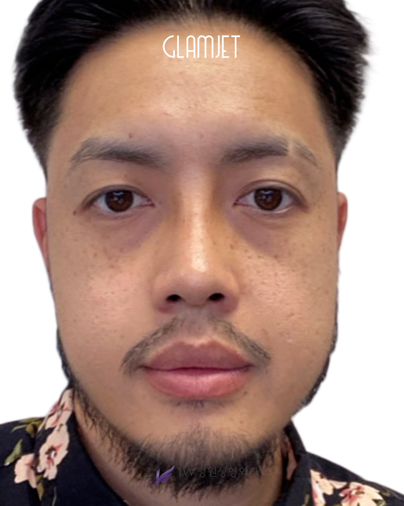 After - Dr. Man: 3D INNORIB rib cartilage rhinoplasty with short nose correction and tip correction