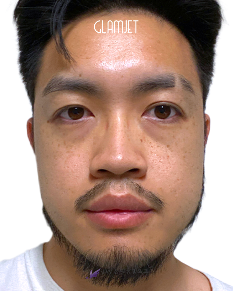 Before - Dr. Man: 3D INNORIB rib cartilage rhinoplasty with short nose correction and tip correction