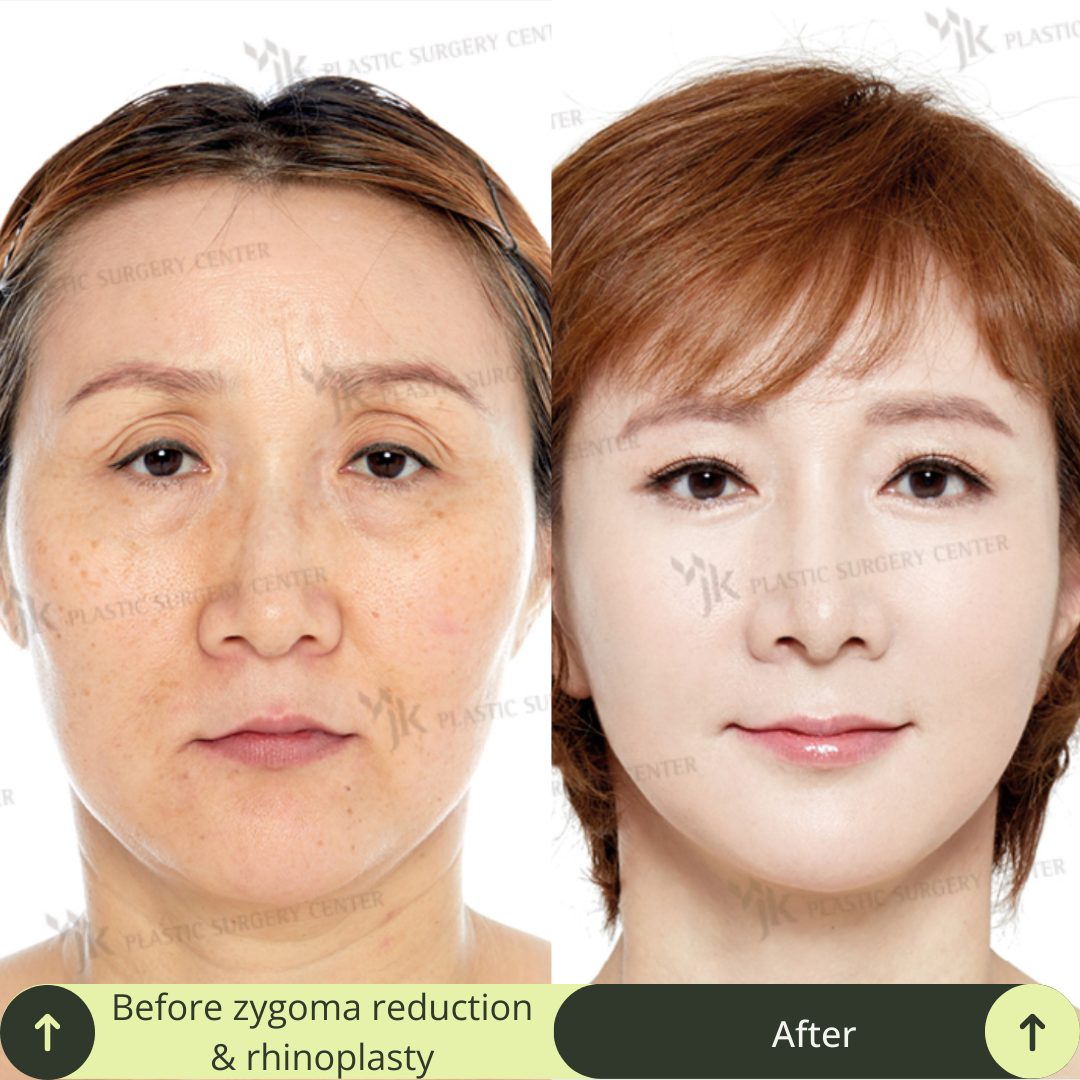 Cheek Bone Zygomatic Reduction Packages In South Korea