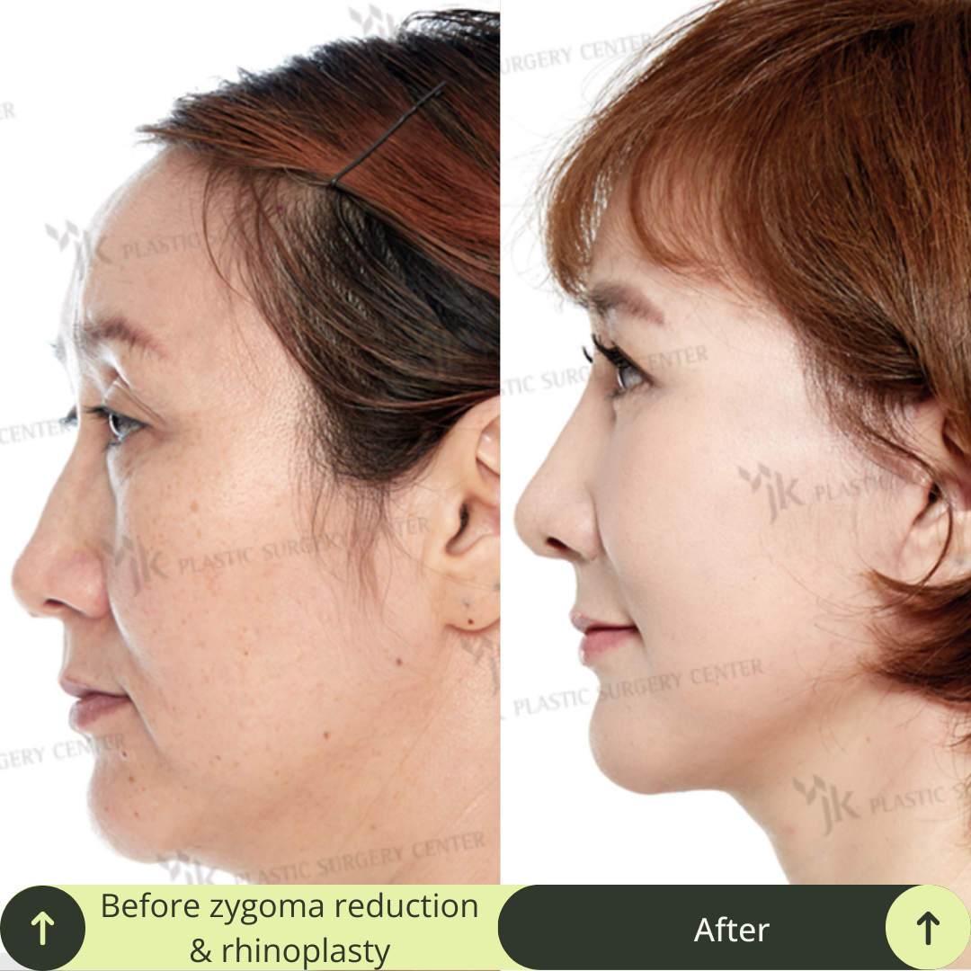 Cheek Bone Zygomatic Reduction Packages In South Korea