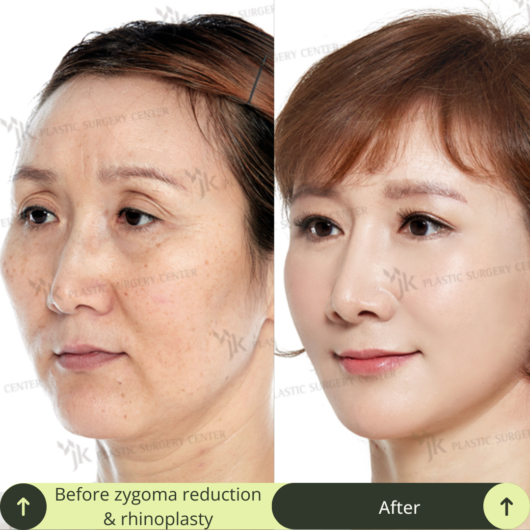 Cheek Bone Zygomatic Reduction Packages In South Korea